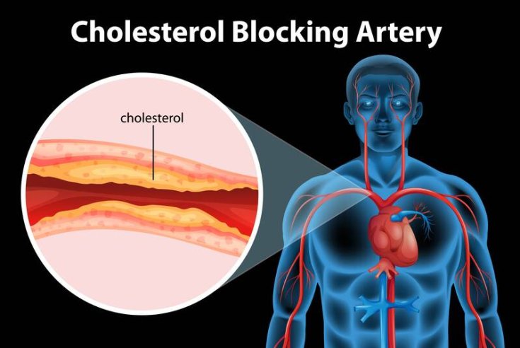  Impact of High Cholesterol on Vascular Health